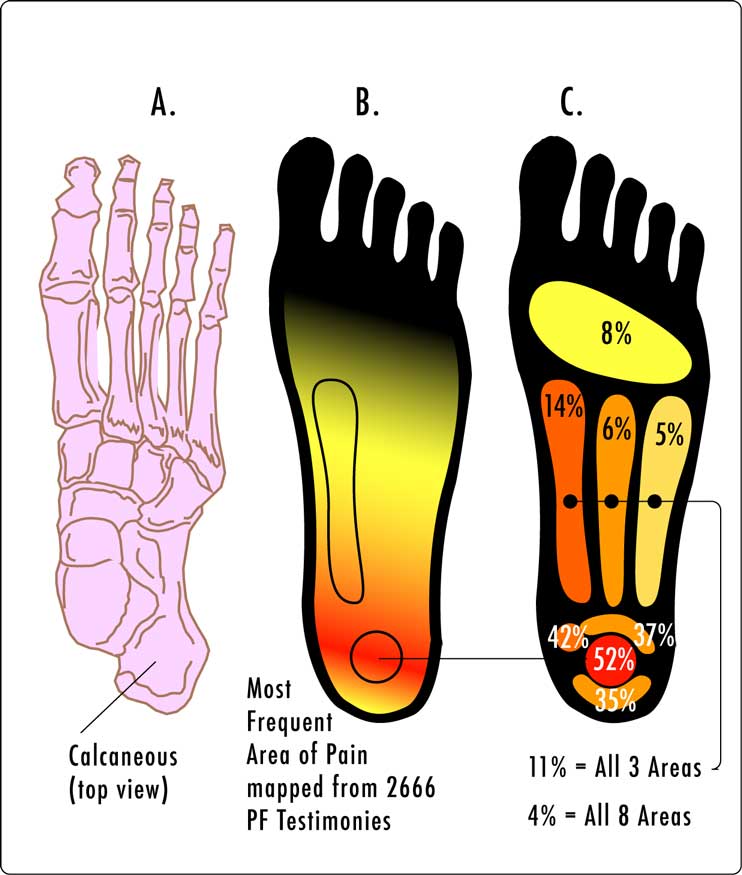 bowen therapy for plantar fasciitis